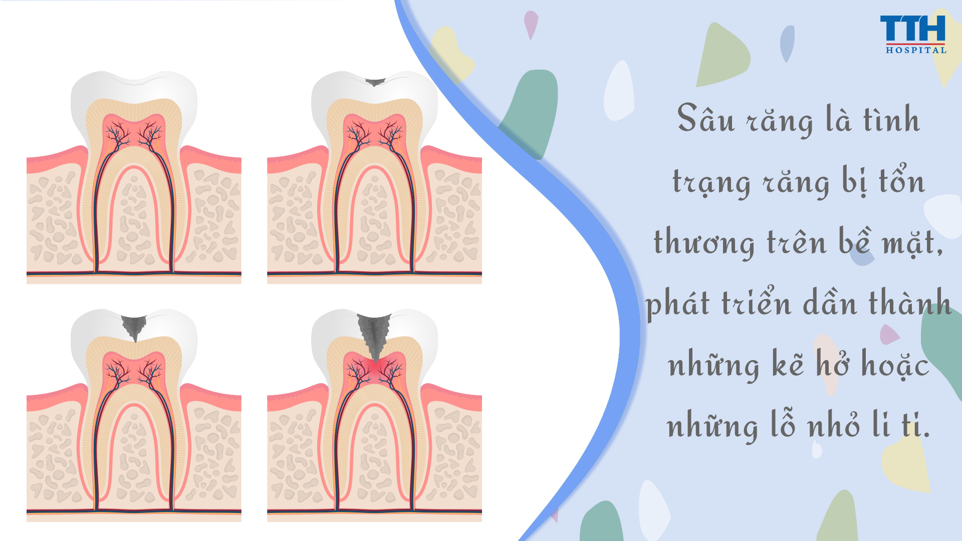 Sâu răng là sự kết hợp của nhiều yếu tố