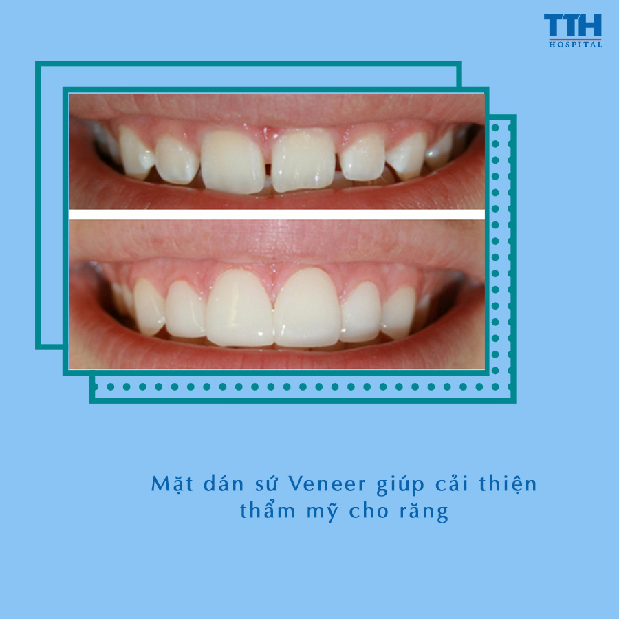 Mặt dán sứ Veneer giúp cải thiện thẩm mỹ cho răng một cách nhanh chóng mà lại tiết kiệm chi phí