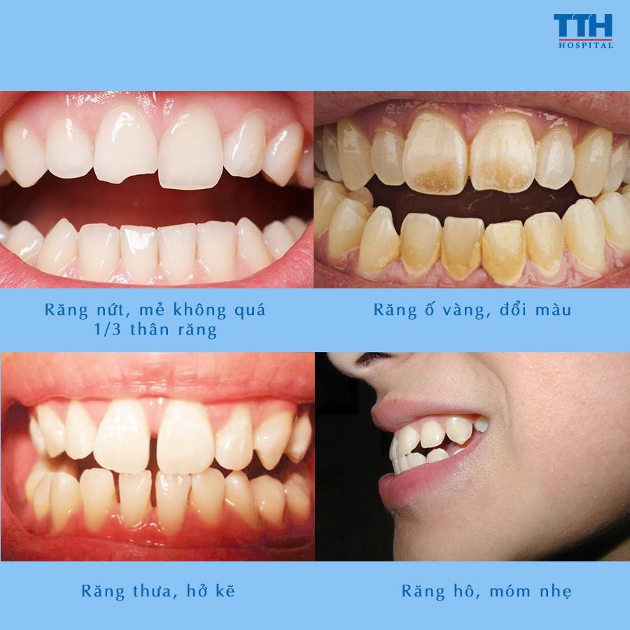 Những trường hợp được chỉ định sử dụng mặt dán sứ Veneer