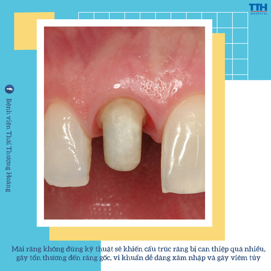 Mài răng không đúng kỹ thuật sẽ khiến cấu trúc răng bị can thiệp quá nhiều, gây tổn thương đến răng gốc
