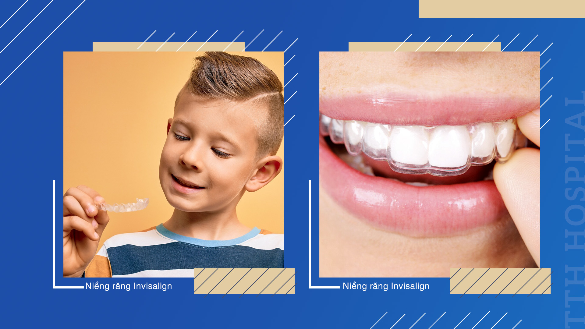 Niềng răng Invisalign đang dần trở thành xu hướng hiện nay với những ưu điểm vượt trội, phù hợp cho cả trẻ em, thanh thiếu niên và người lớn