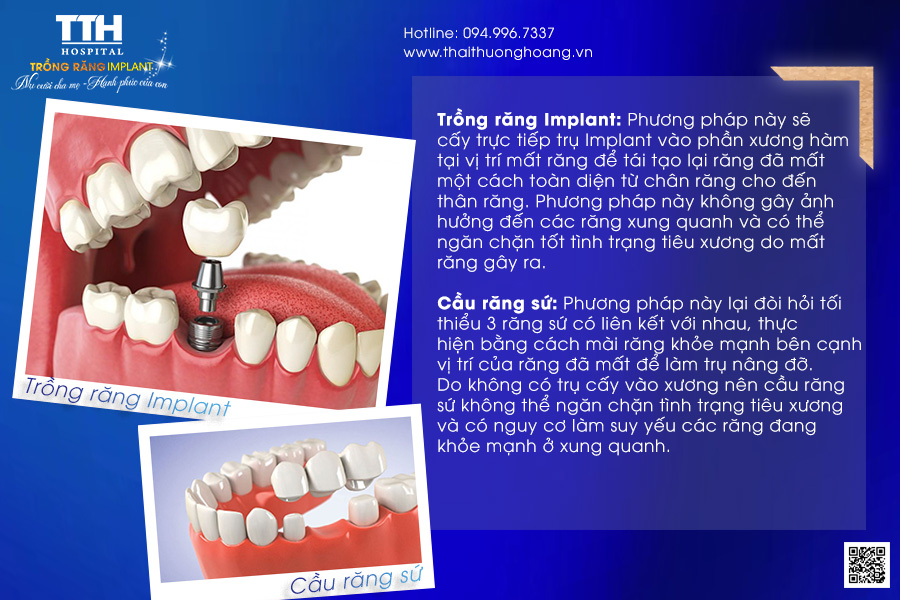 SO SÁNH TRỒNG RĂNG IMPLANT VỚI CẦU RĂNG SỨ