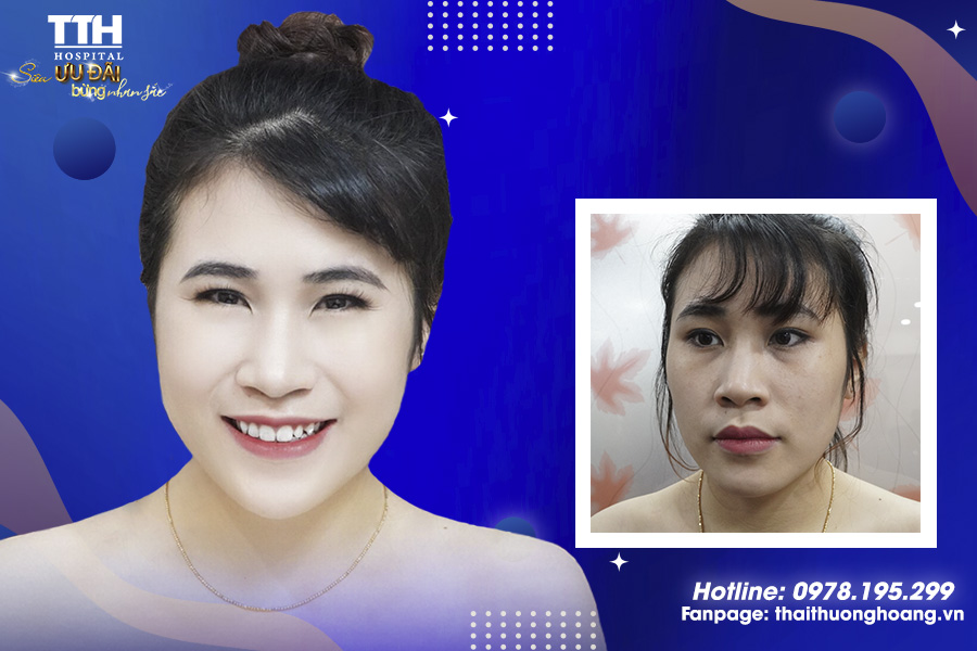 TIÊM VI ĐIỂM HA PHÙ HỢP VỚI NHỮNG AI?