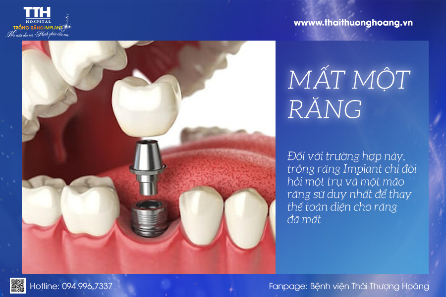 Trường hợp mất 1 răng
