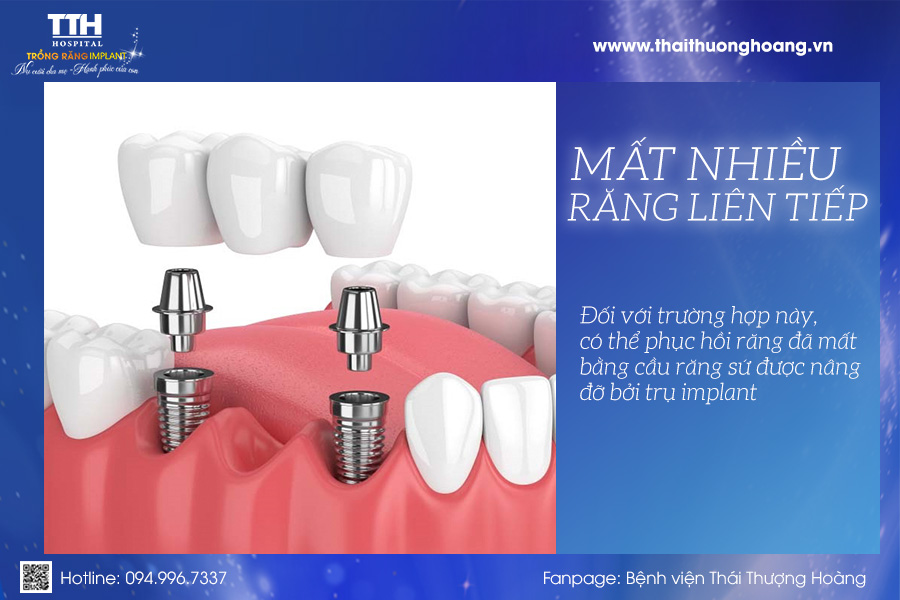 Trường hợp mất nhiều răng