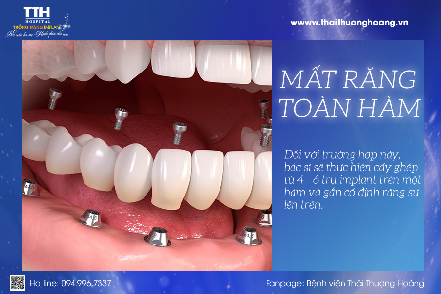 Trường hợp mất răng toàn hàm