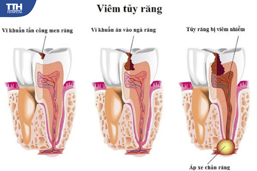 Thường thì sâu răng là nguyên nhân chính gây ra viêm tủy