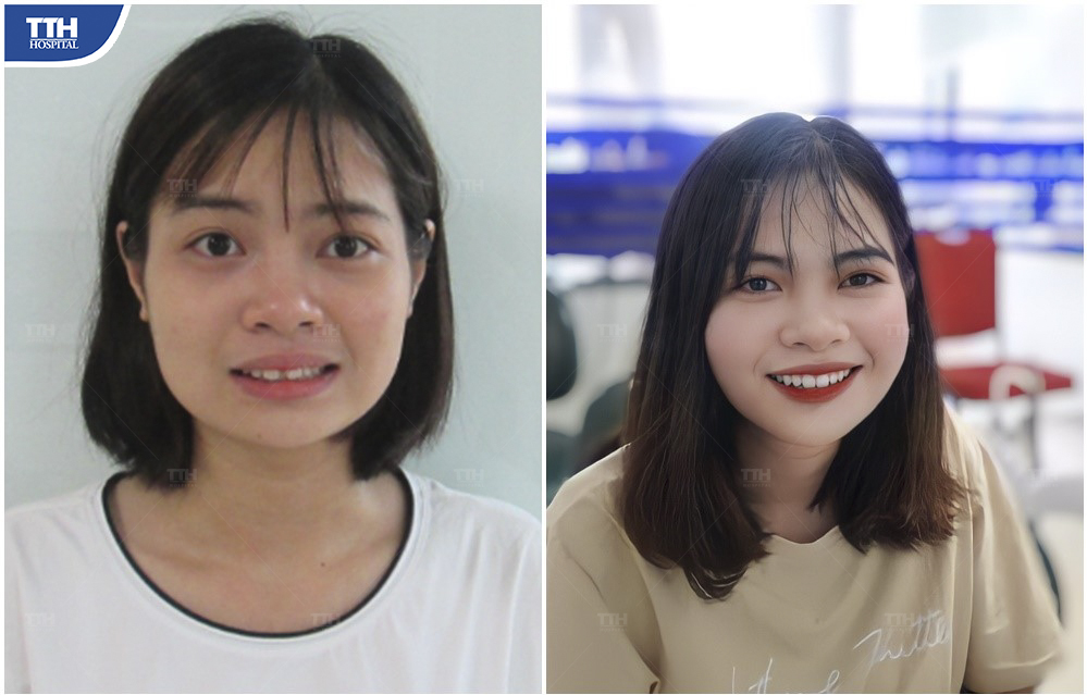 Kết quả niềng răng của Khách hàng 1 tại bệnh viện Thái Thượng Hoàng