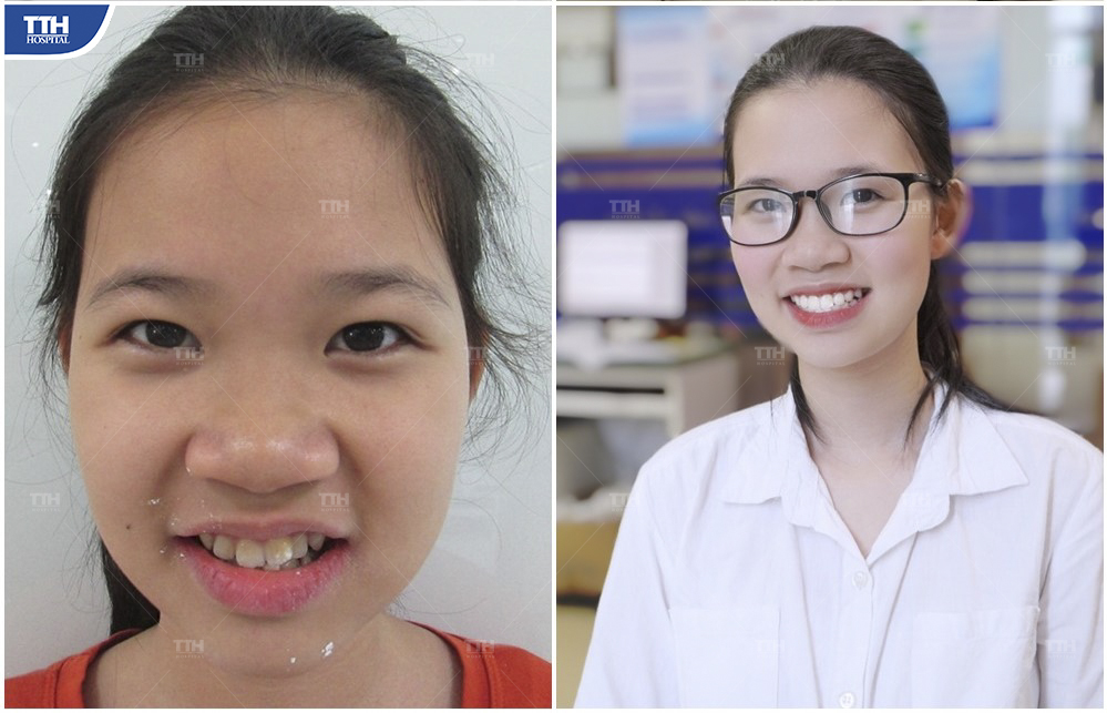 Kết quả niềng răng của Khách hàng 2 tại bệnh viện Thái Thượng Hoàng