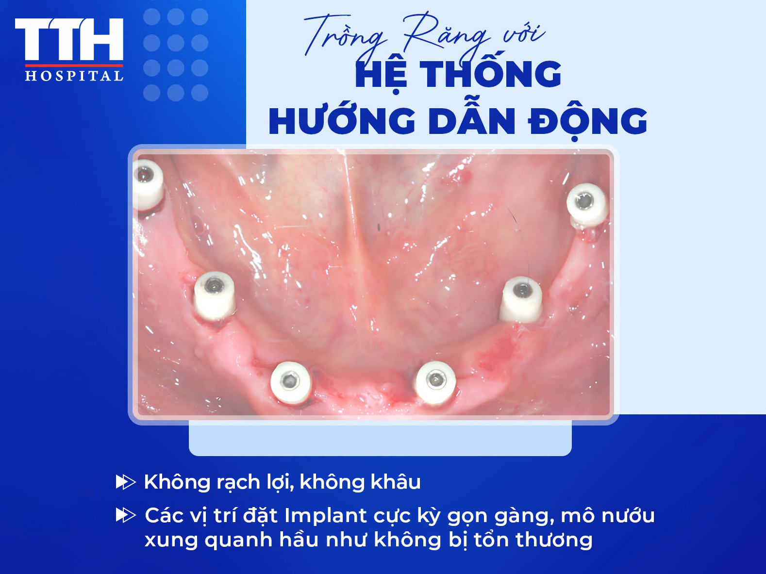 Việc ứng dụng DCARER cũng giúp vùng thao tác đặt Implant