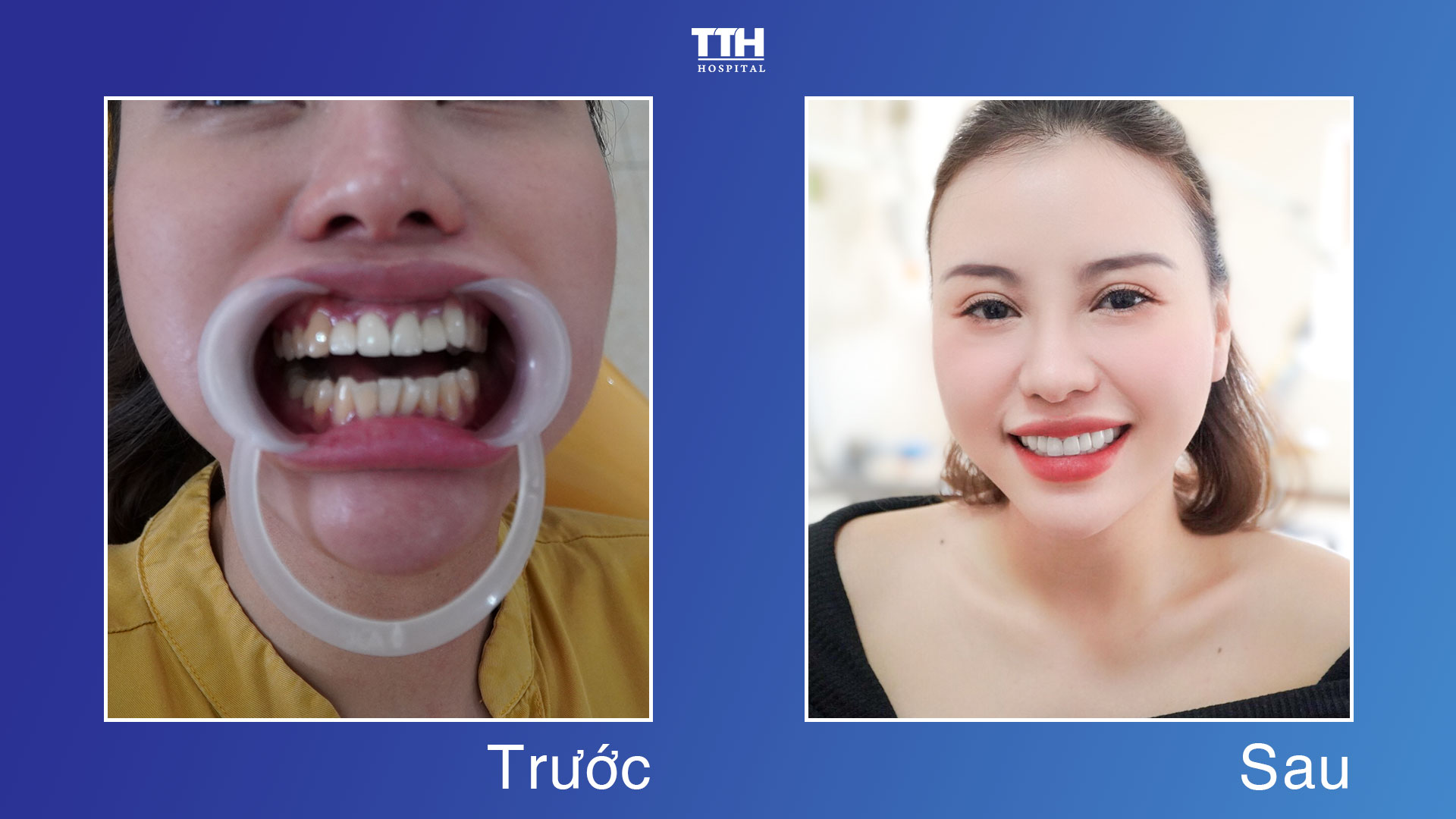 MỘT SỐ HÌNH ẢNH KHÁCH HÀNG SAU KHI THẨM MỸ RĂNG SỨ TẠI BỆNH VIỆN THÁI THƯỢNG HOÀNG