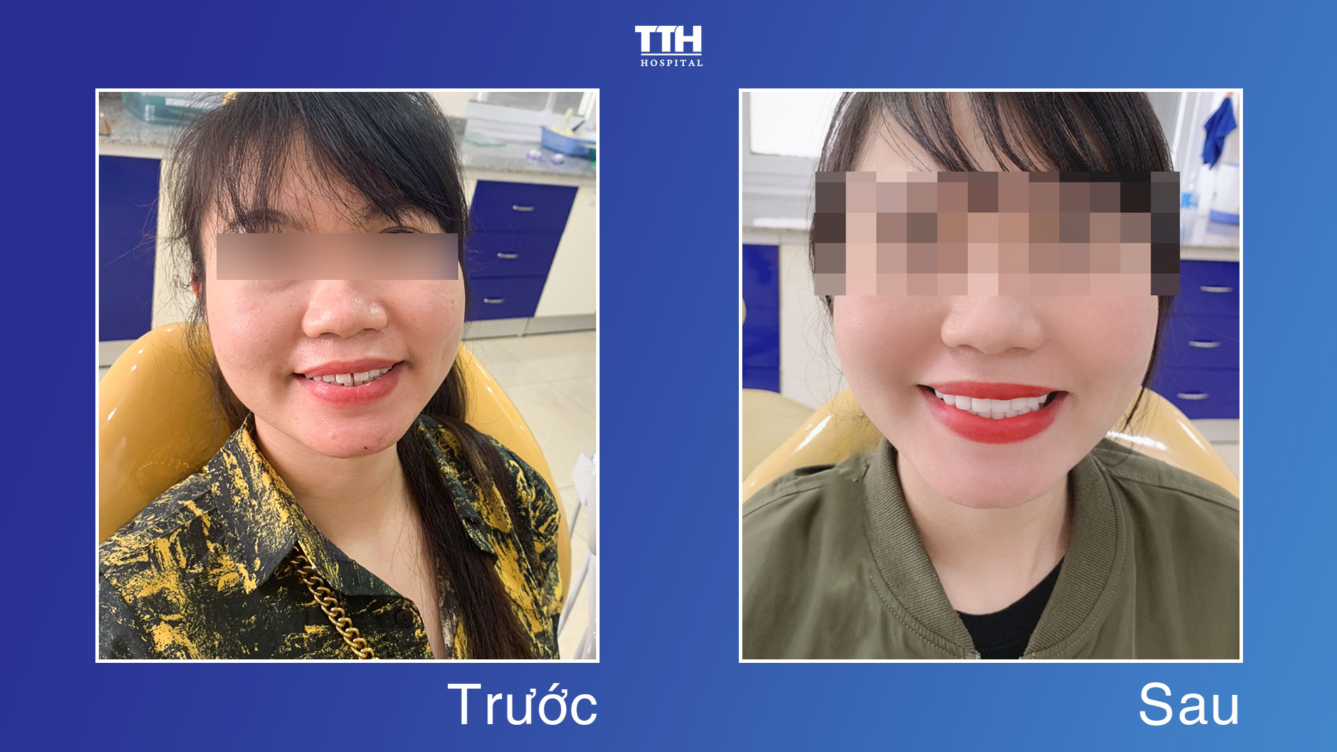 MỘT SỐ HÌNH ẢNH KHÁCH HÀNG SAU KHI THẨM MỸ RĂNG SỨ TẠI BỆNH VIỆN THÁI THƯỢNG HOÀNG 1