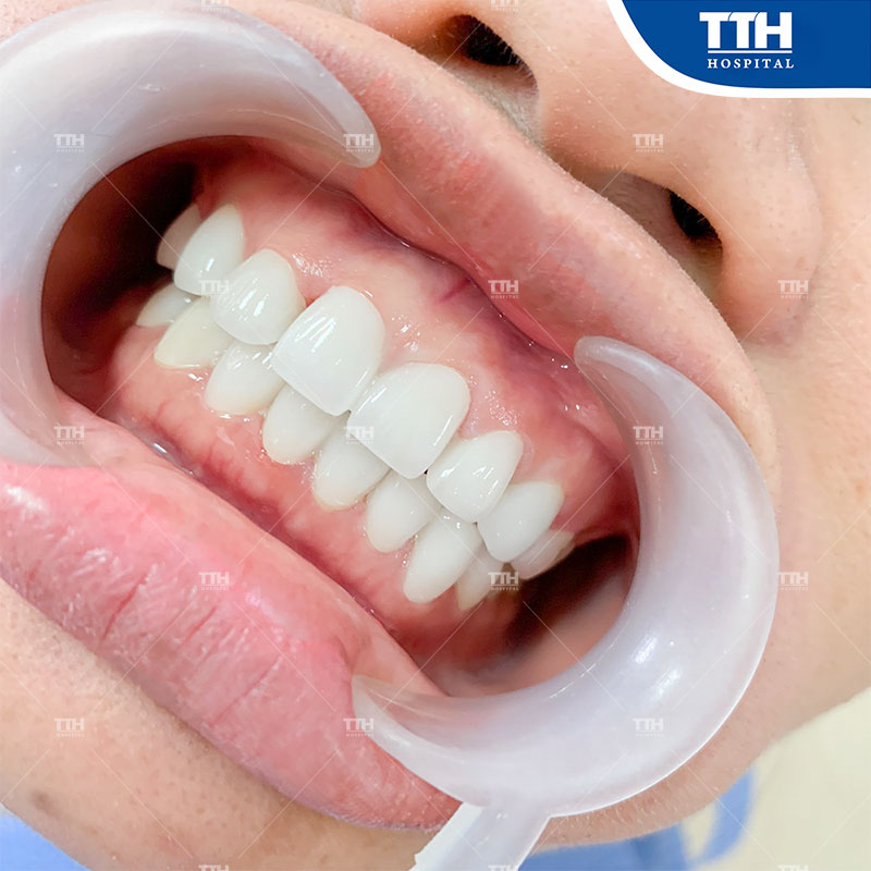 Bọc răng sứ cho răng nhiễm màu kháng sinh Tetracycline là giải pháp hiệu quả nhất