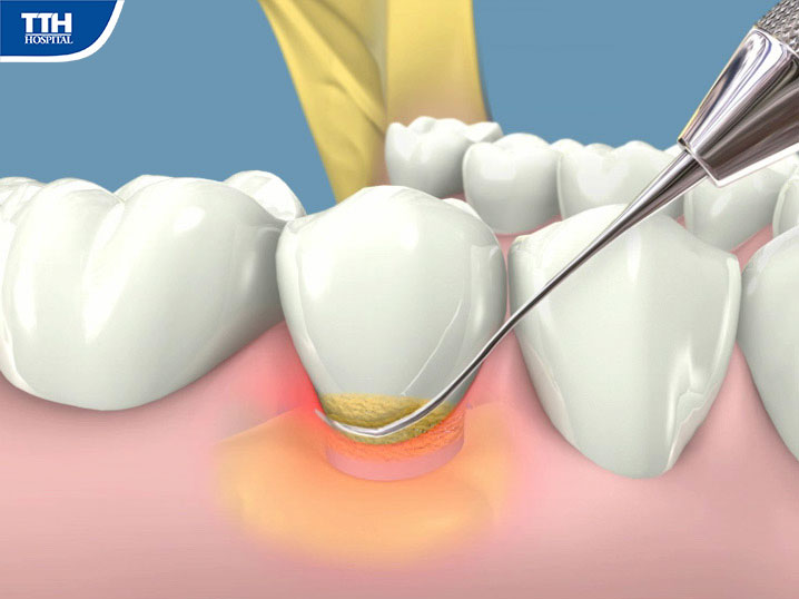 Lấy cao răng sẽ giúp hạn chế mắc phải các bệnh lý răng miệng như viêm lơi, viêm nha chu, ...