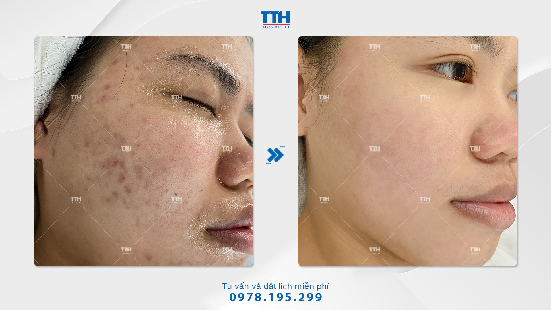 Kết quả điều trị mụn của khách hàng tại Bệnh viện Thái Thượng Hoàng