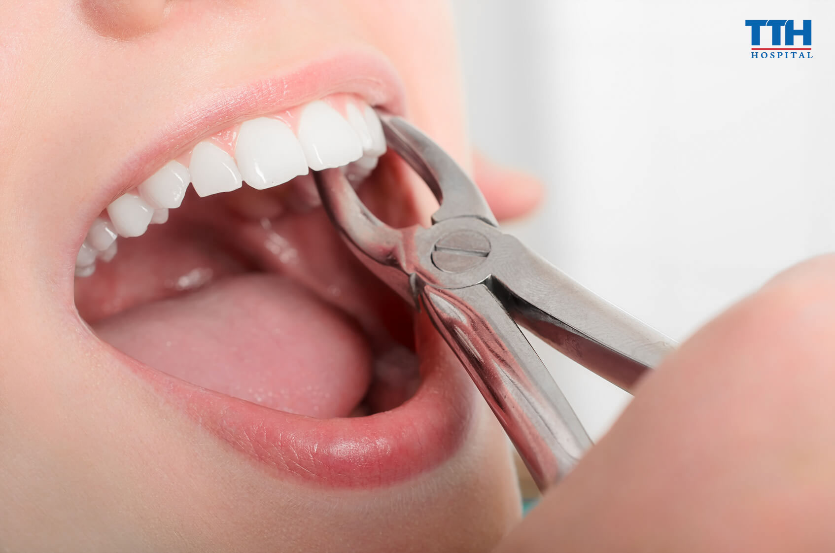 Trường hợp nào cần nhổ răng khi niềng răng