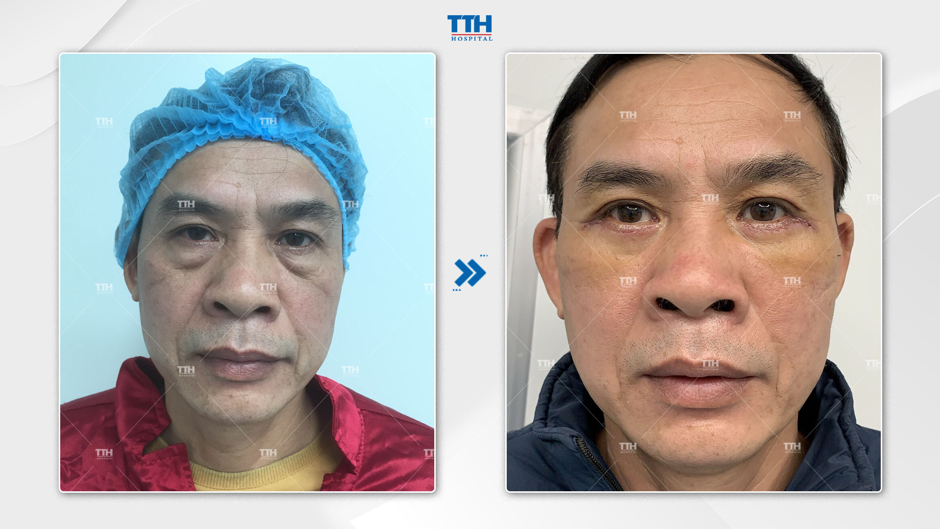 Lưu ý chăm sóc sau khi lấy mỡ bọng mắt