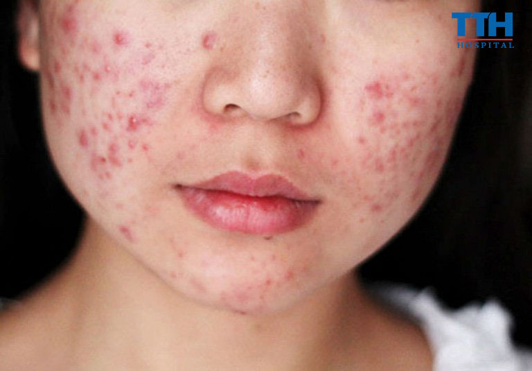 Các loại mụn thường gặp