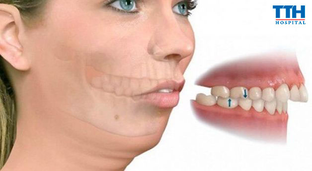 Ảnh hưởng tới ăn nhai