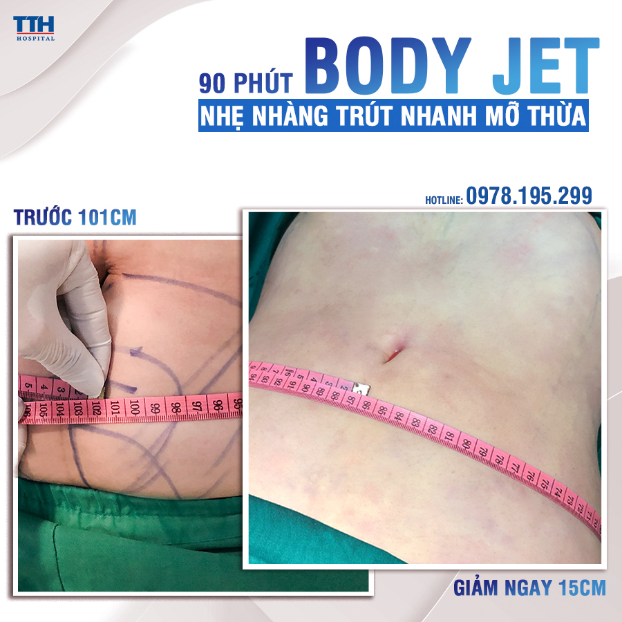 Kết quả khách hàng sau hút mỡ bụng tại Bệnh viện Thái Thượng Hoàng