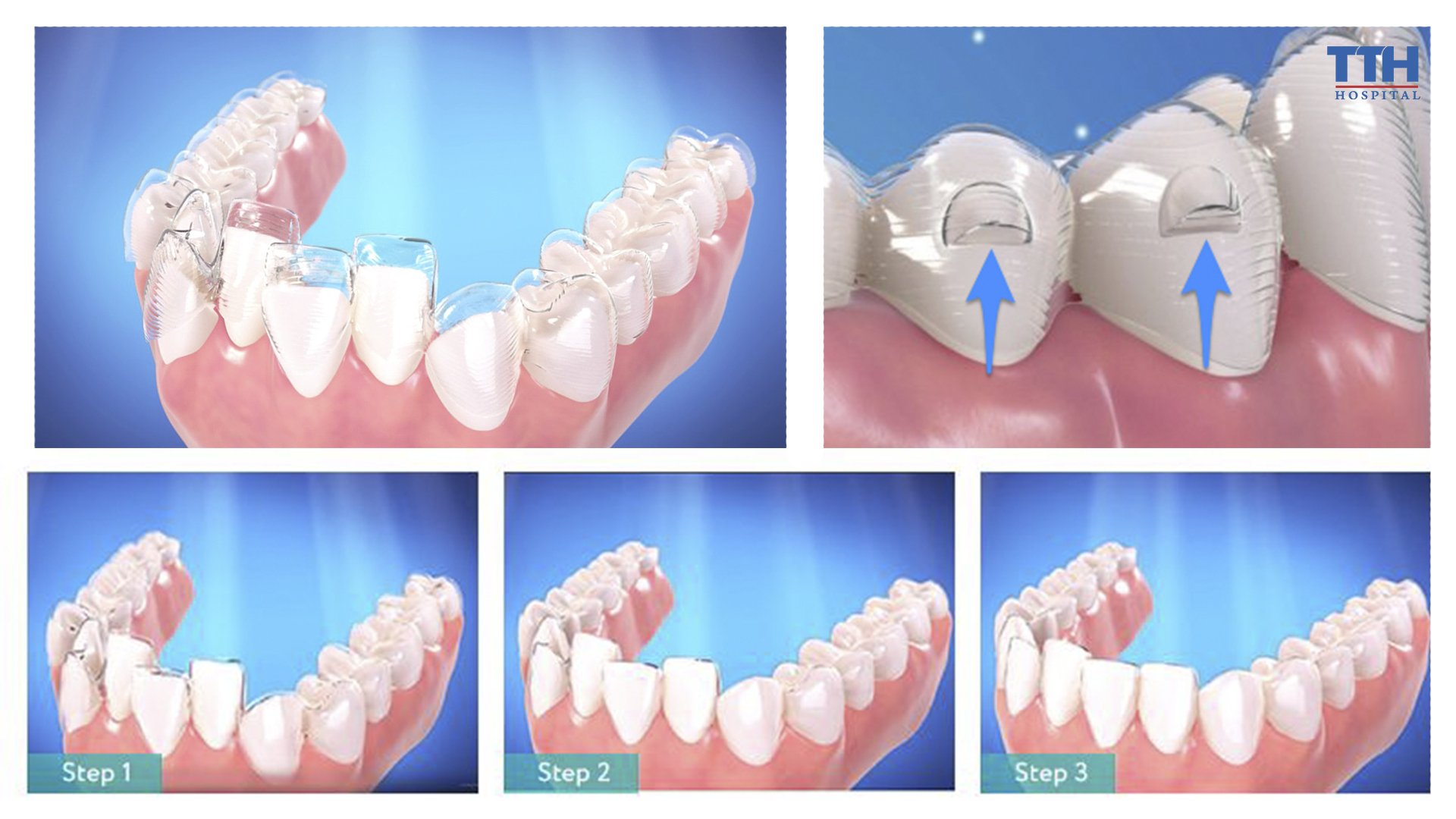 Lực và khoảng cách di chuyển răng được tính toán một cách chính xác ngay từ đầu