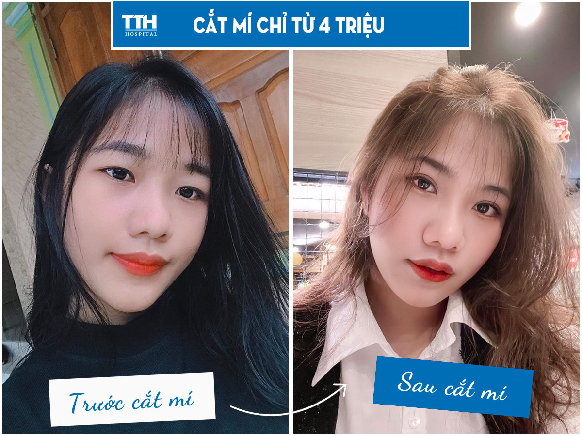 Cắt mí chỉ từ 4 triệu