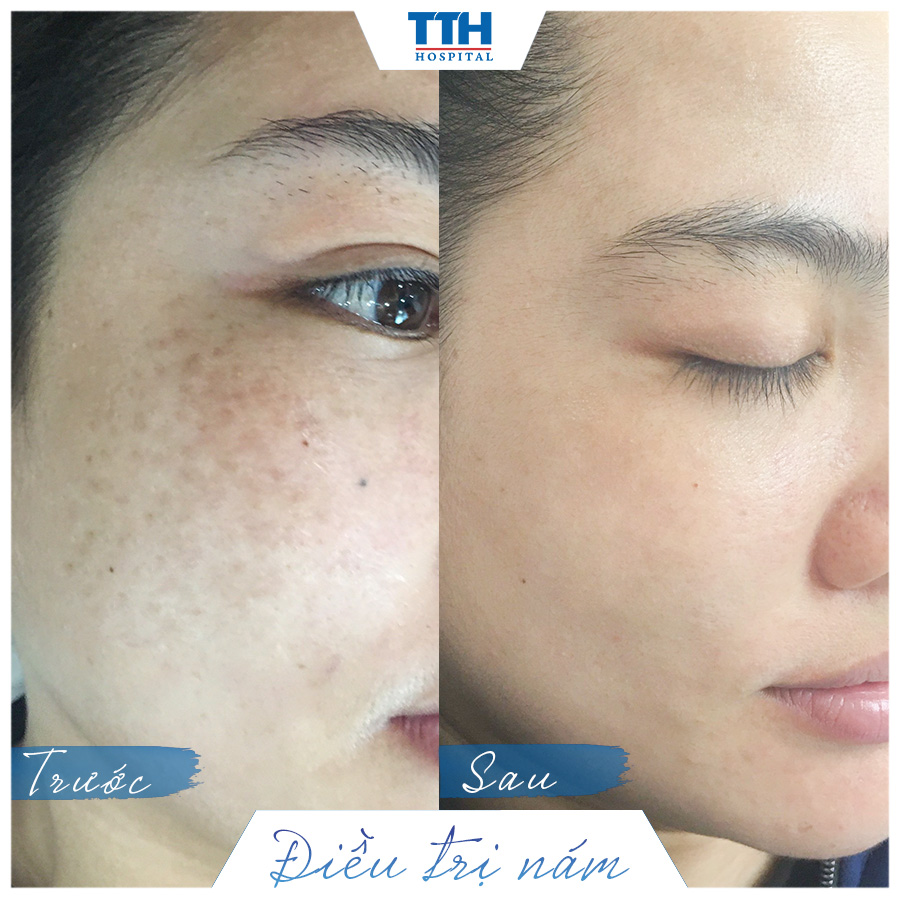 Kết quả khách hàng sau khi laser điều trị nám tại Bệnh viện Thái Thượng Hoàng