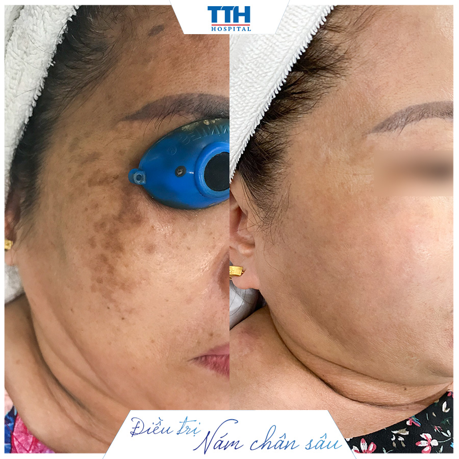 Bệnh viện Răng Hàm mặt và PTTHTM Thái Thượng Hoàng là địa chỉ điều trị nám uy tín tại Nghệ An