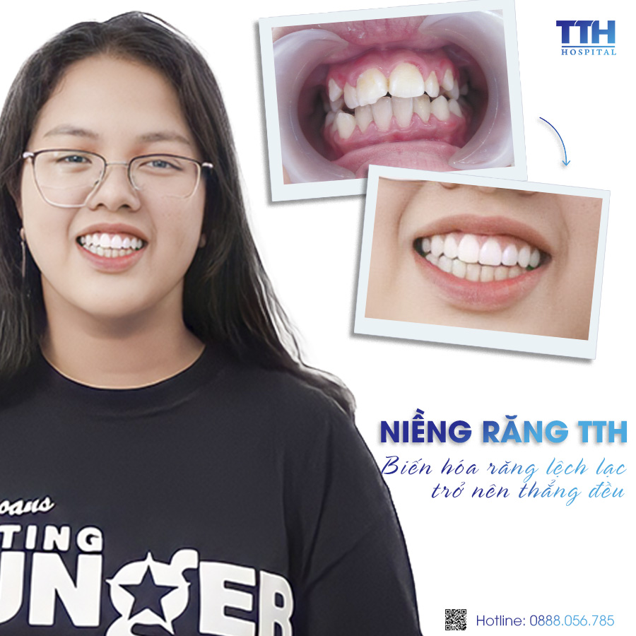 Loạt hình ảnh khách hàng sau khi niềng răng tại Bệnh viện Thái Thượng Hoàng 9