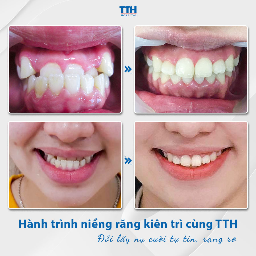 Loạt hình ảnh khách hàng sau khi niềng răng tại Bệnh viện Thái Thượng Hoàng 3