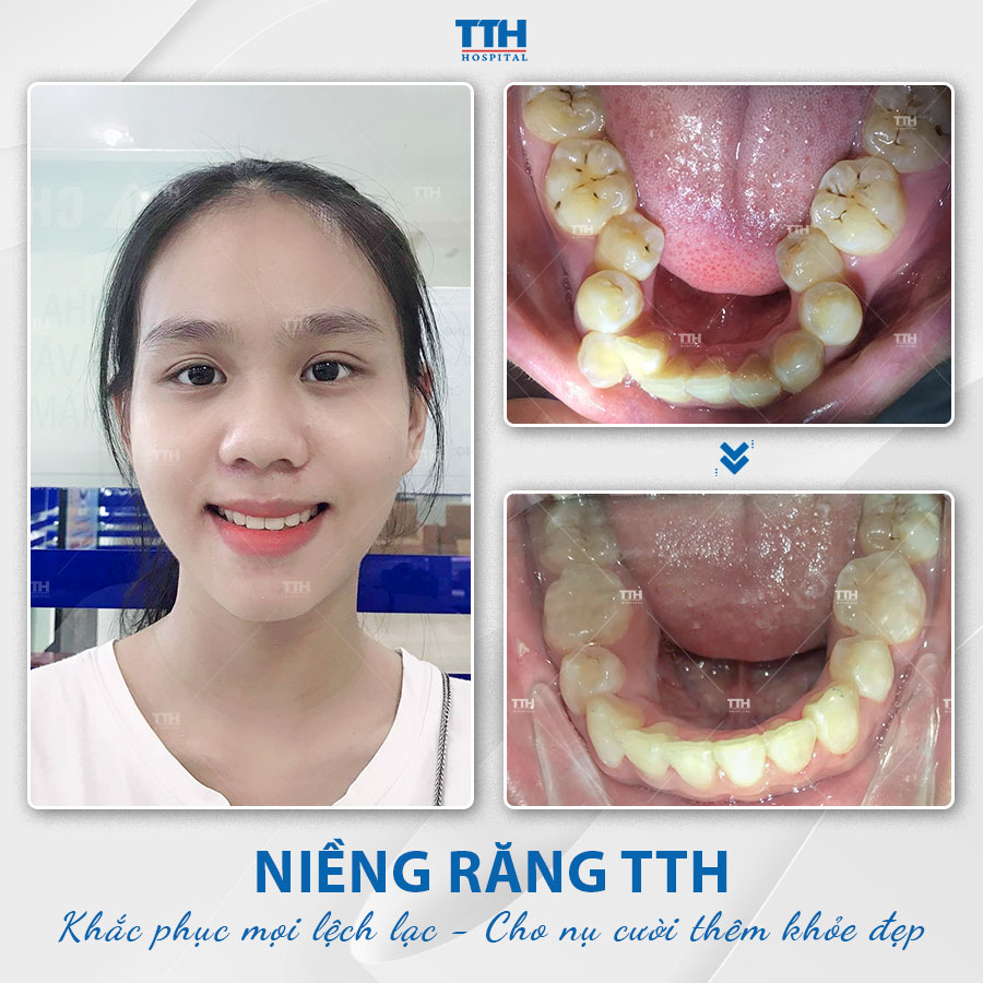 Loạt hình ảnh khách hàng sau khi niềng răng tại Bệnh viện Thái Thượng Hoàng 7