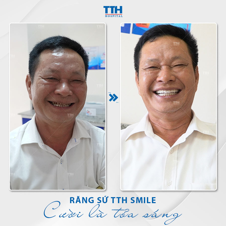 MỘT SỐ HÌNH ẢNH KHÁCH HÀNG SAU KHI THẨM MỸ RĂNG SỨ TẠI BỆNH VIỆN THÁI THƯỢNG HOÀNG