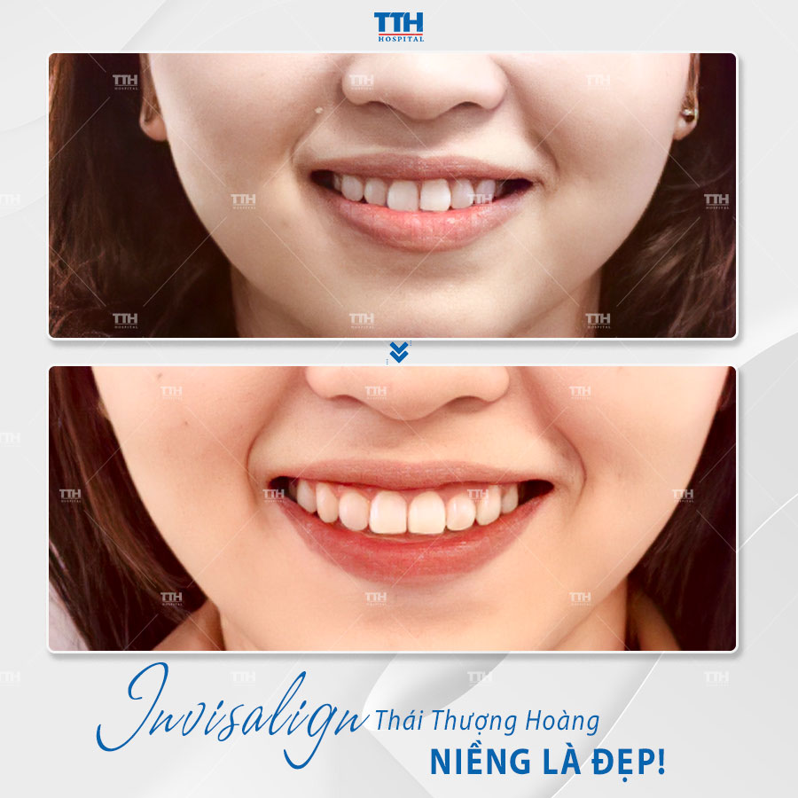 Loạt hình ảnh khách hàng sau khi niềng răng tại Bệnh viện Thái Thượng Hoàng 10