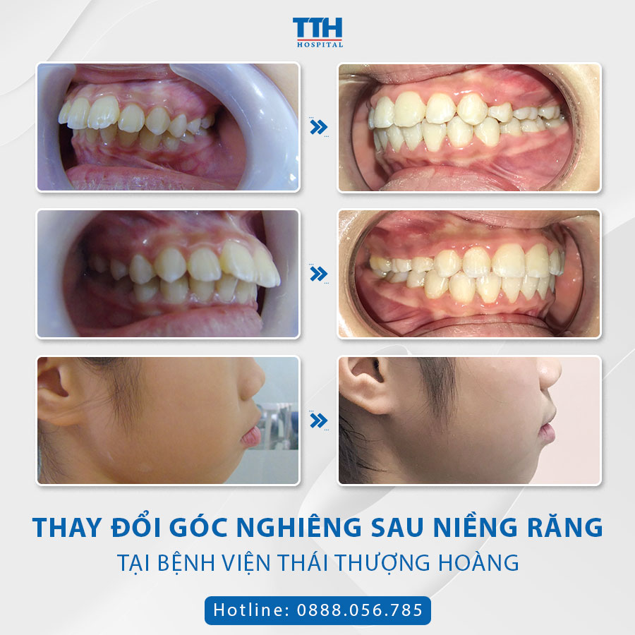 Một số hình ảnh khách hàng niềng răng tại bệnh viện Thái Thượng Hoàng 2