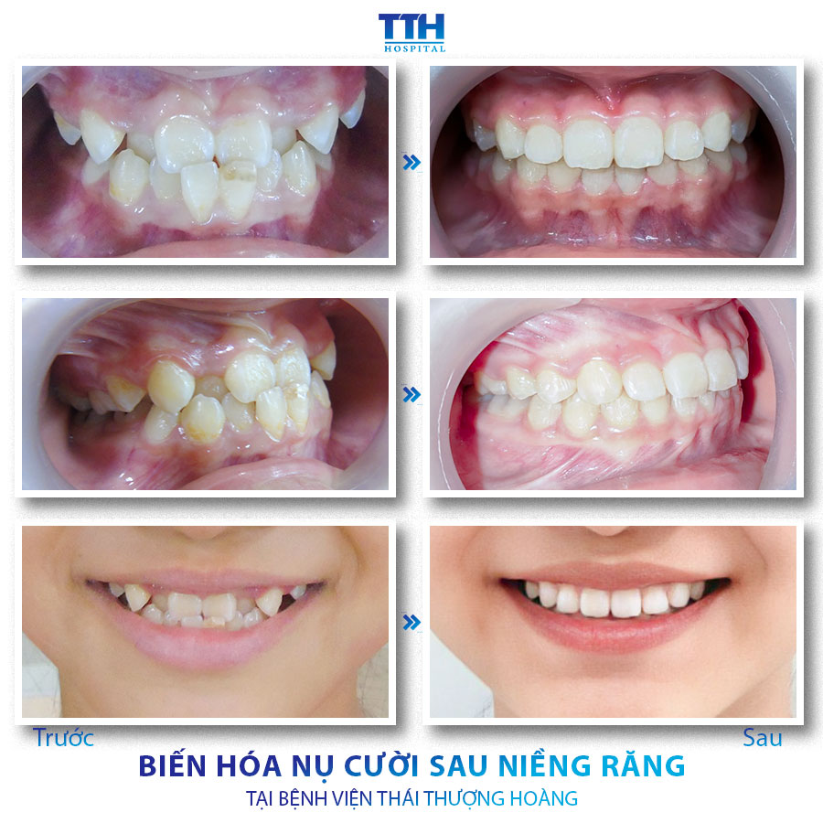 Một số hình ảnh khách hàng niềng răng tại bệnh viện Thái Thượng Hoàng 1