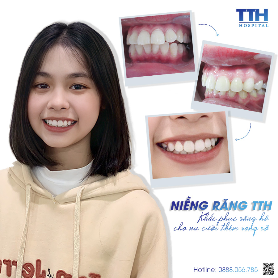 Hình ảnh khách hàng sau khi niềng răng tại Bệnh viện Thái Thượng Hoàng 2