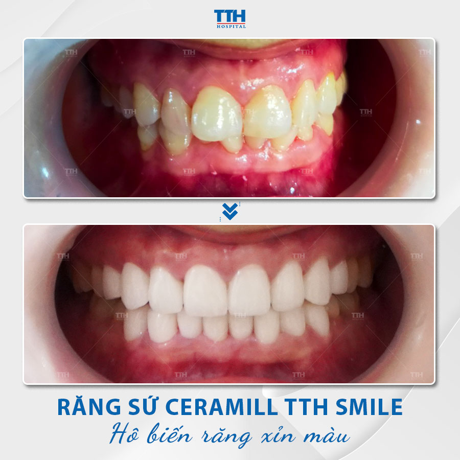 Các trường hợp nên bọc răng sứ thẩm mỹ 1