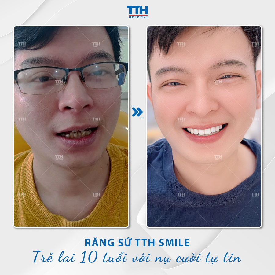 Ưu điểm bọc răng sứ thẩm mỹ