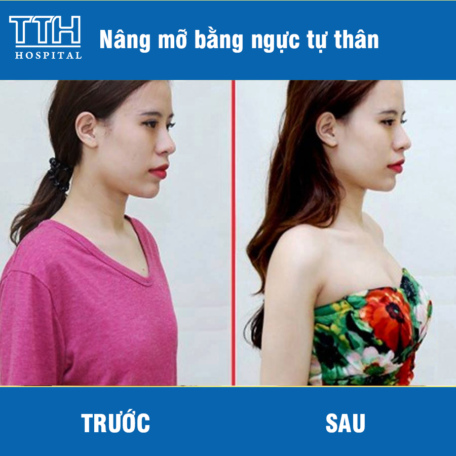 Khắc phục tình trạng 2 bên bị lệch, không cân đối