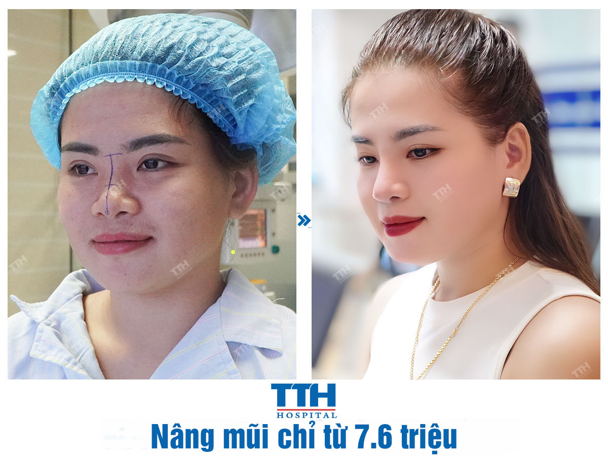 Nâng mũi chỉ từ 7.6 triệu