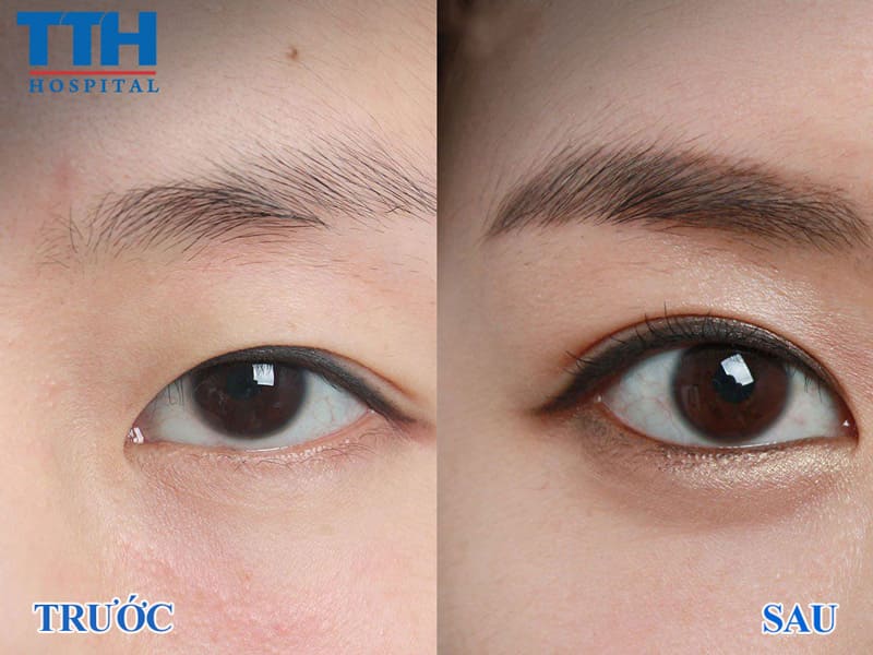Nên chọn cắt mí Perfect Eyes hay Mini Deep?