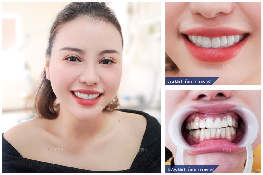 Hình ảnh khách hàng trước và sau khi bọc răng sứ tại bệnh viện TTH