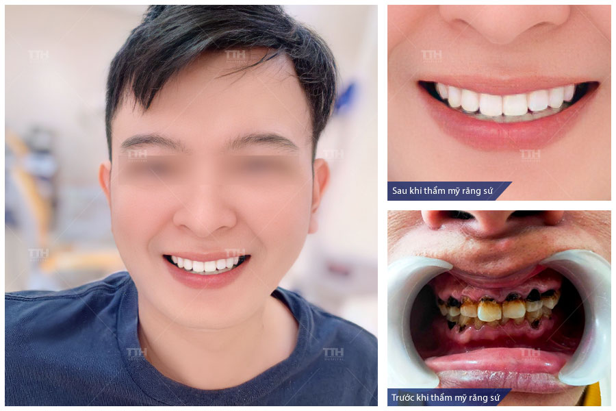 MỘT SỐ HÌNH ẢNH KHÁCH HÀNG SAU KHI THẨM MỸ RĂNG SỨ TẠI BỆNH VIỆN THÁI THƯỢNG HOÀNG.