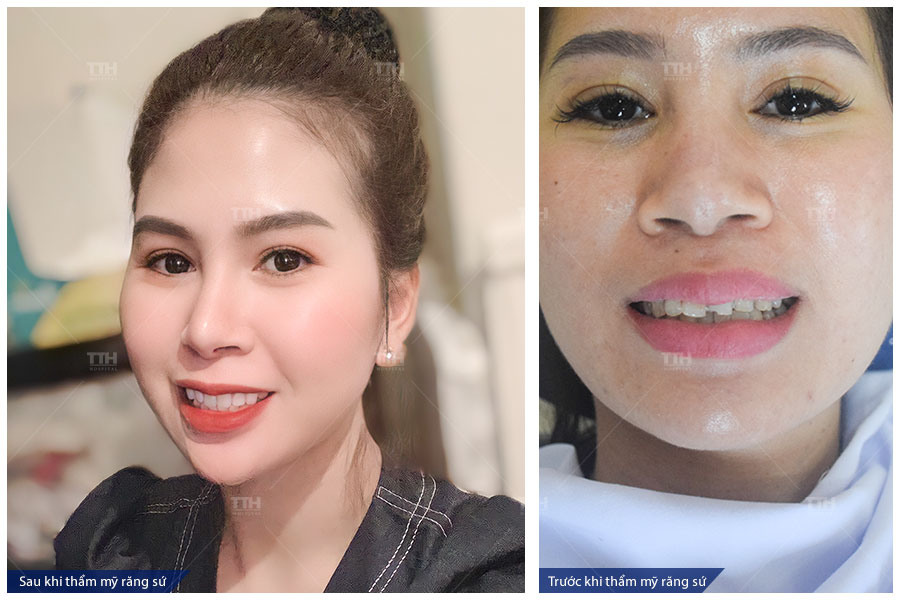 ƯU ĐIỂM BỌC RĂNG SỨ THẨM MỸ