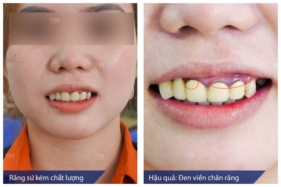 Đen viền chân răng