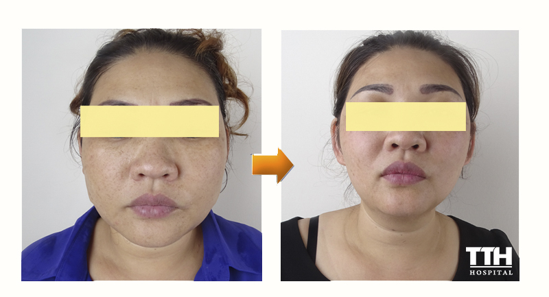 Kết quả sau khi nâng cơ hifu 2