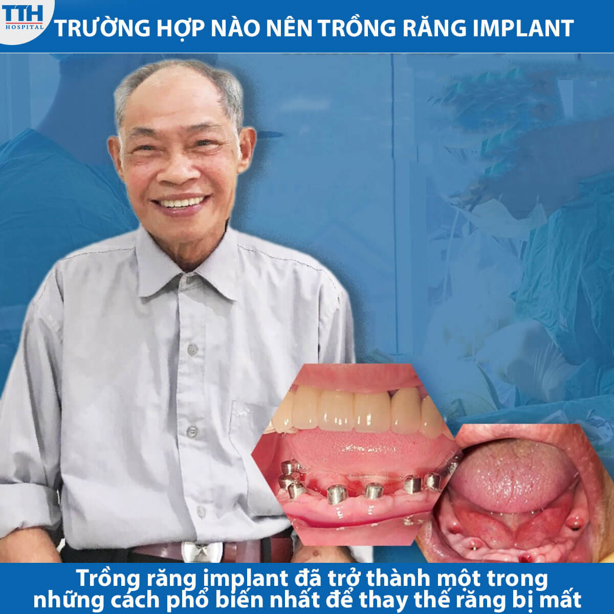 Trường hợp nào nên trồng răng implant