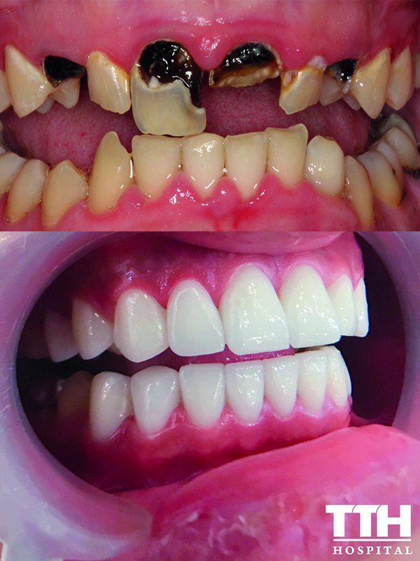 Răng bị hư, chết tủy
