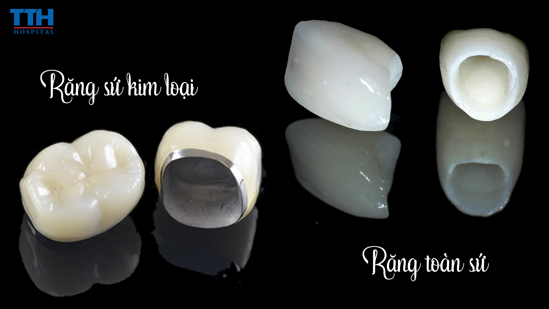Răng sứ kim loại và răng toàn sứ có chất liệu khác nhau