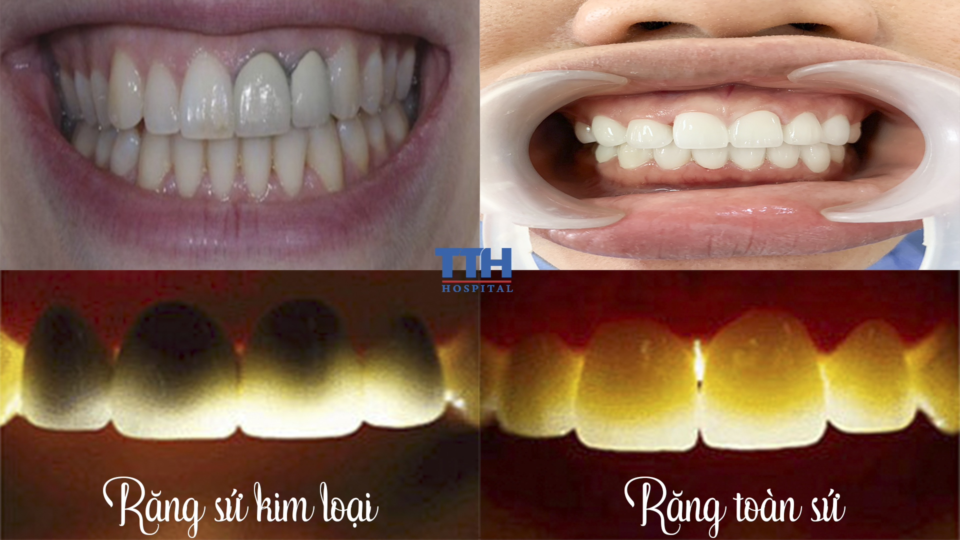Răng sứ kim loại và răng toàn sứ có sự khác biệt rõ về màu sắc răng và độ ảnh hưởng nướu